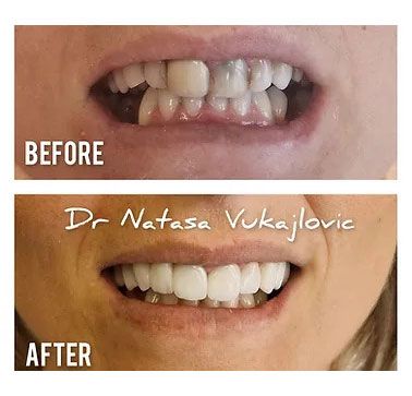 Vorher / Nachher Ergebnis