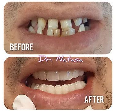 Vorher / Nachher Ergebnis