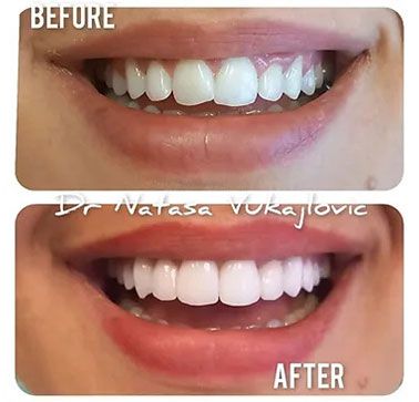 Vorher / Nachher Ergebnis