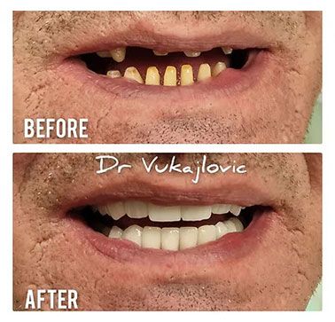 Vorher / Nachher Ergebnis