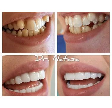 Vorher / Nachher Ergebnis